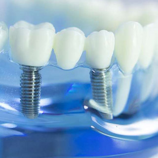 Dental Implants Coventry